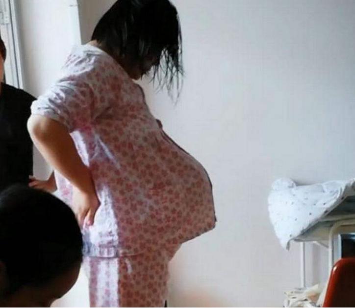 孕妇悬浮肚产后如何修复,孕妇悬浮肚怎么纠正