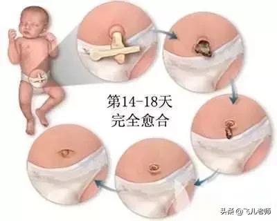 新生儿脐带一个月了还不掉怎么办,新生儿脐带一个多月未脱落