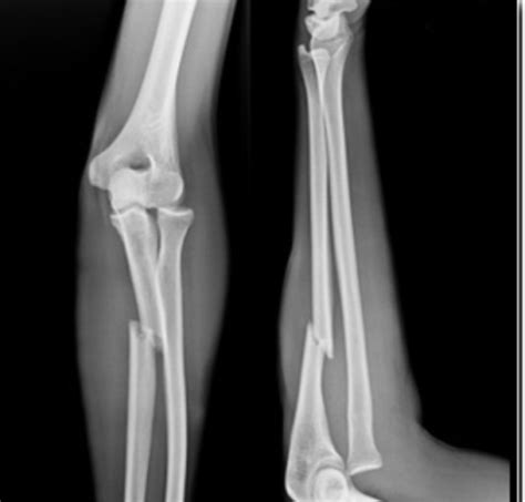 腰椎间盘突出针灸能治彻底吗,腰椎间盘突出针灸治疗能彻底吗