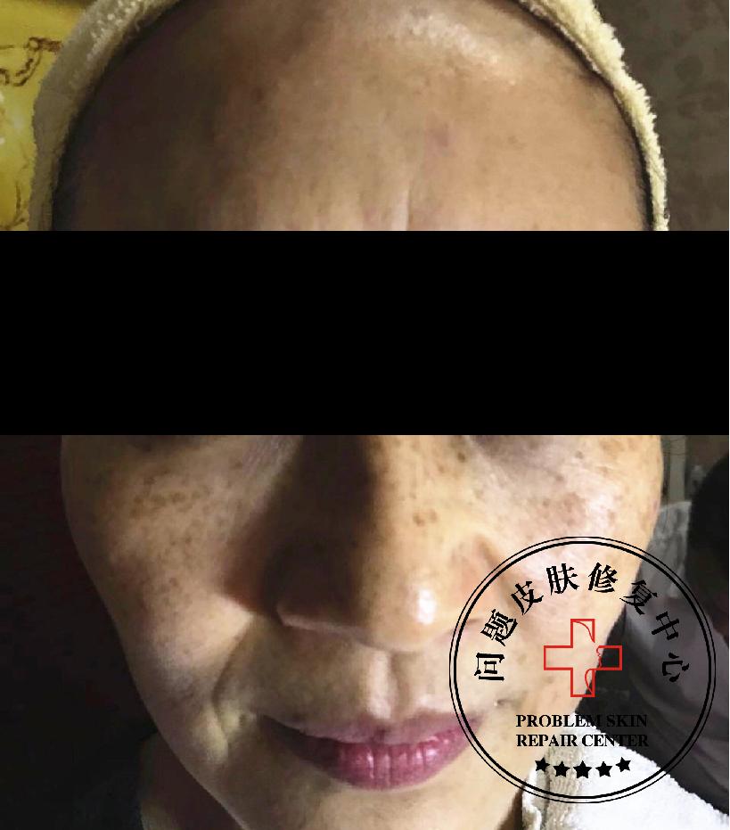 激光祛斑反黑修复过程,激光反黑了怎么修复