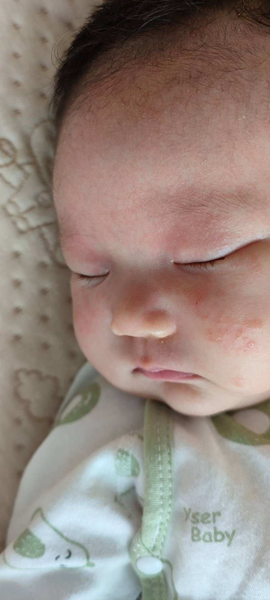 根治湿疹特效药,宝宝湿疹大作战图文