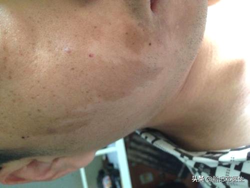 如何阻止咖啡斑增长,怎么避免咖啡斑长脸上