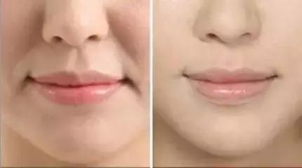 你知道什么是玻尿酸吗,如何快速了解玻尿酸品类