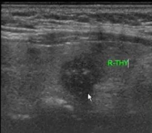 手术根治能彻底治愈吗,手术做不好怎么处理