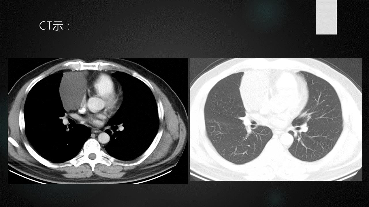 前上纵隔高密度影考虑胸腺未退化,肺纵隔胸腺结节12mm看什么科