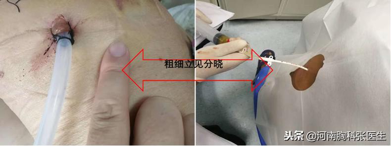 看看医生如何微创治疗胸腔积气积液？