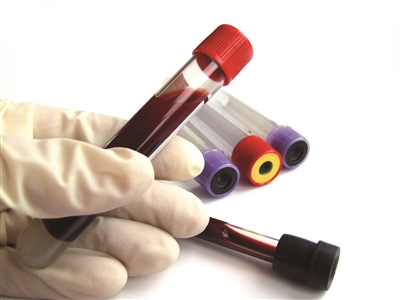 糖尿病的人糖化血红蛋白7.5严重吗,糖尿病人糖化血红蛋白6.7严重吗