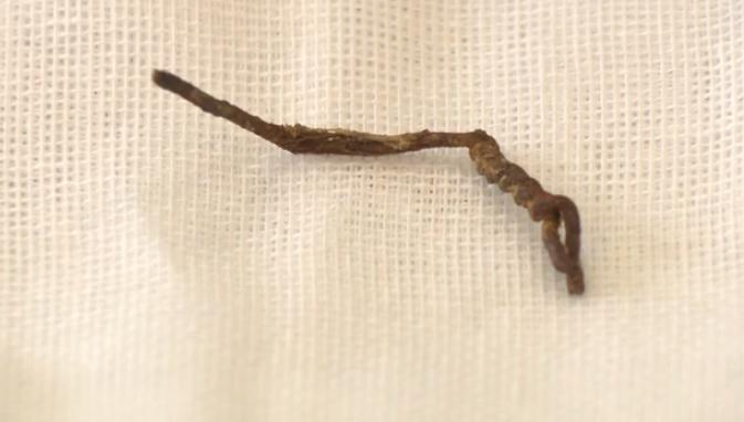 误食异物卡在喉咙真实案件,男子误吞6公分鱼刺肠道被戳