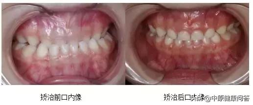 这个三岁的孩子笑的时候看不见上牙，吃饭嚼不烂就咽了