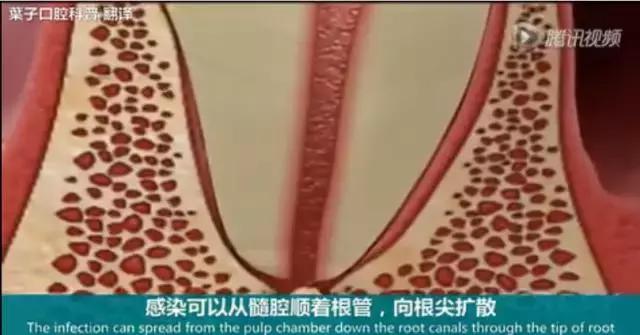 上牙龈上火突出一个鼓包,牙龈肿胀鼓包上火了吗