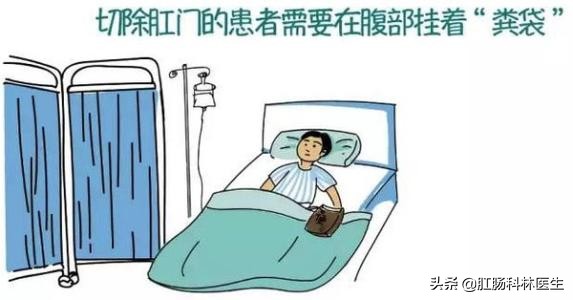 直肠癌不保肛手术得多长时间恢复,结直肠癌手术造口后多久恢复正常