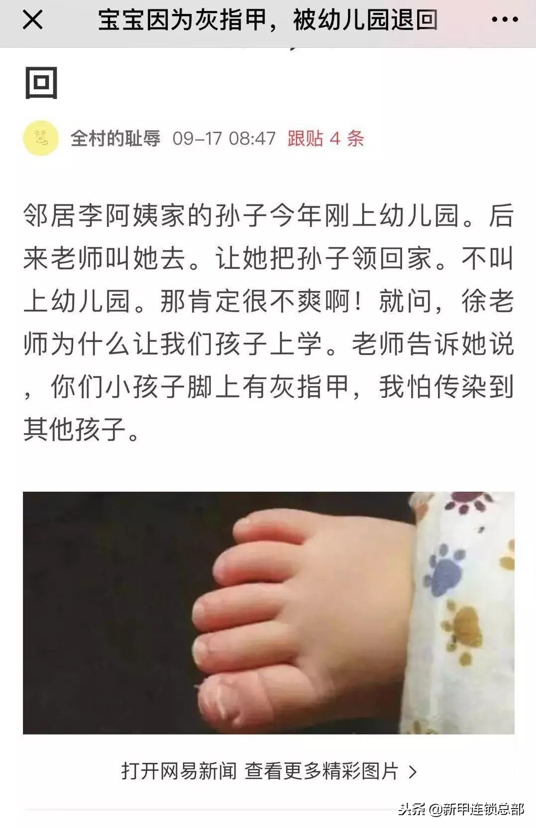 因为灰指甲，被儿媳嫌弃，不让带孙子，幼儿园被退学！新甲连锁