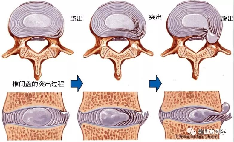 瑜伽拉伸不是拉韧带，韧带拉伤后果很严重