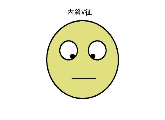 正常眼位和斜视眼位,斜视眼的几大症状