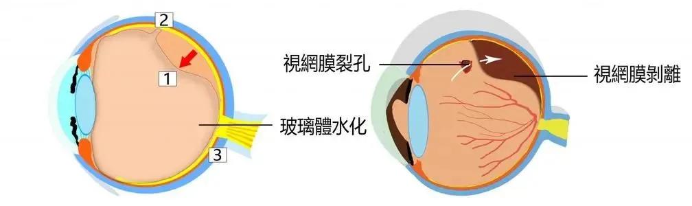 巩膜加固为什么能防止视网膜脱落,后巩膜加固术近视度数降低