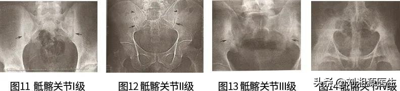 免疫相关不良妊娠答疑解惑,怀孕如何避免强直性脊柱炎