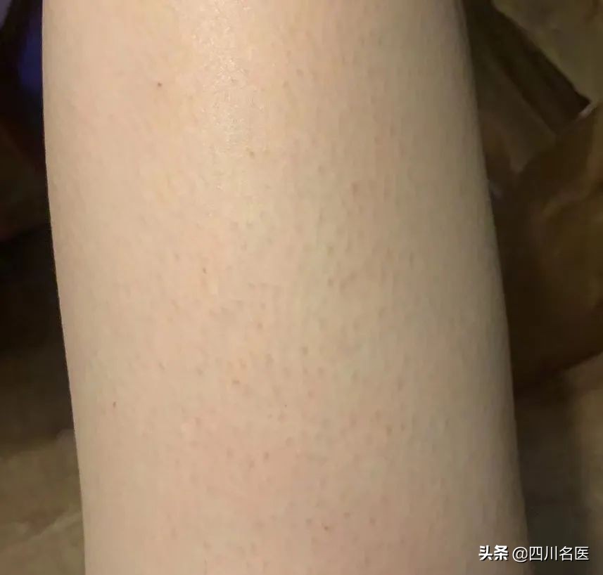 鸡皮肤太丑怎么办啊,鸡皮肤太丑怎么处理好看