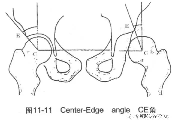 先天性髋关节脱位,先天性髋关节脱位属不属于残疾人