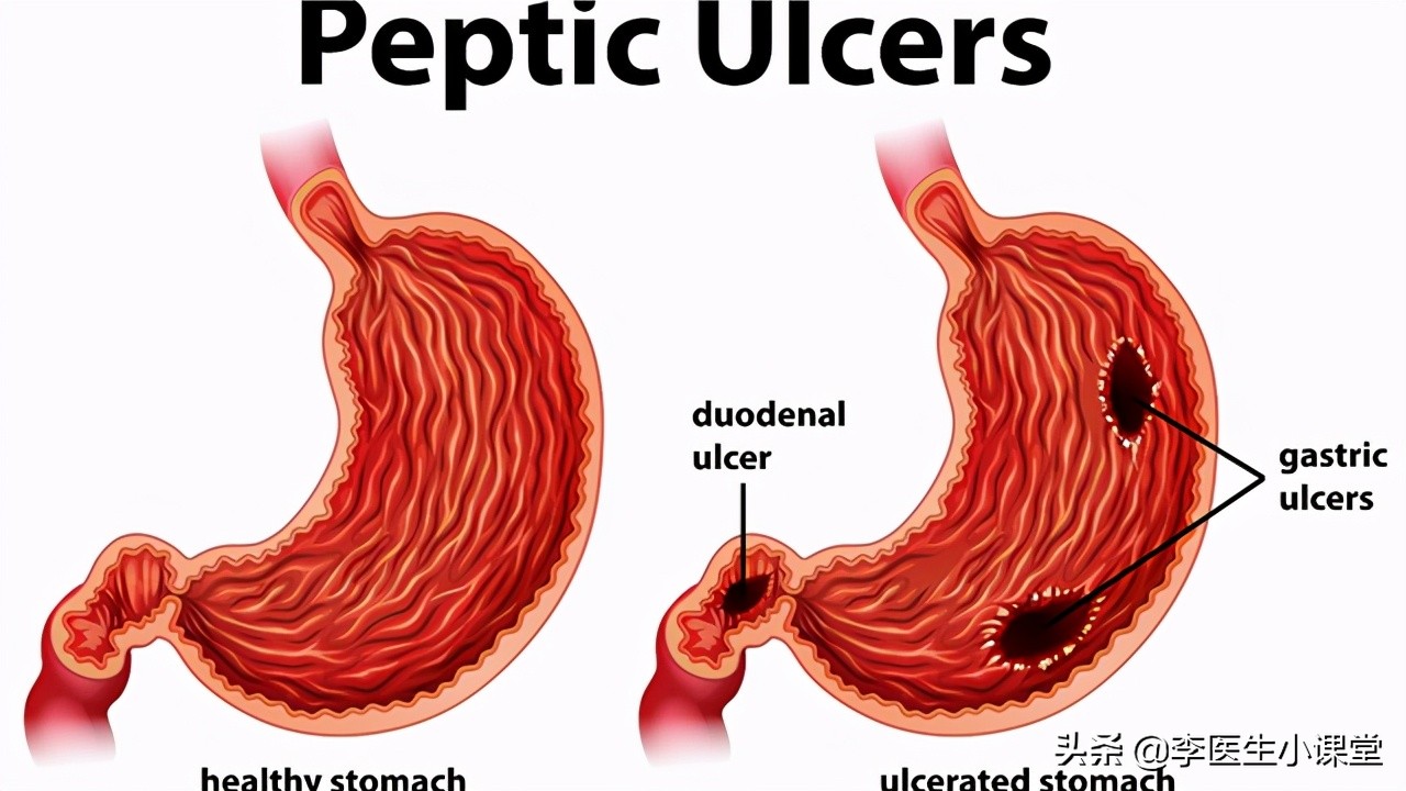 胃肠粘膜受损治好了,胃肠道黏膜受损症状