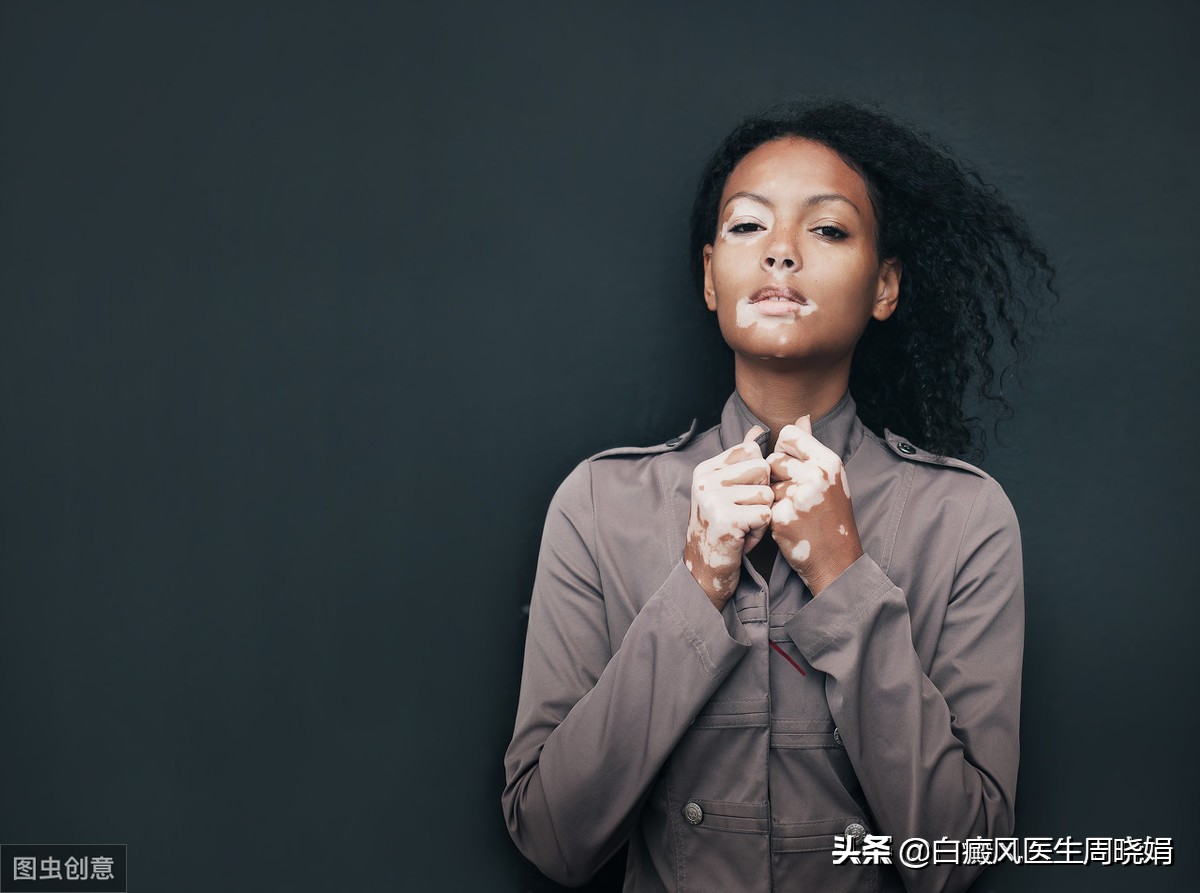 吃什么中药可以治愈白癜风,眼角白癜风擦什么药好