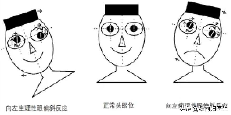 良性位置性眩晕鉴别,怎样判断眩晕是颈椎还是耳石症