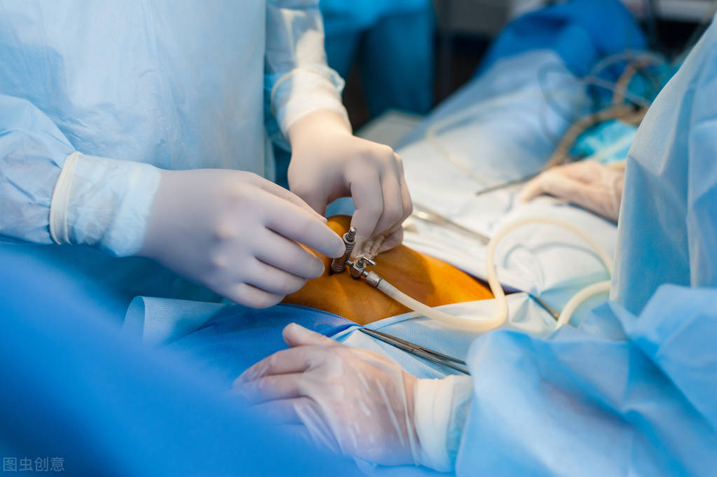 巧克力囊肿和子宫内膜异位,子宫内膜异位症和巧克力囊肿区别