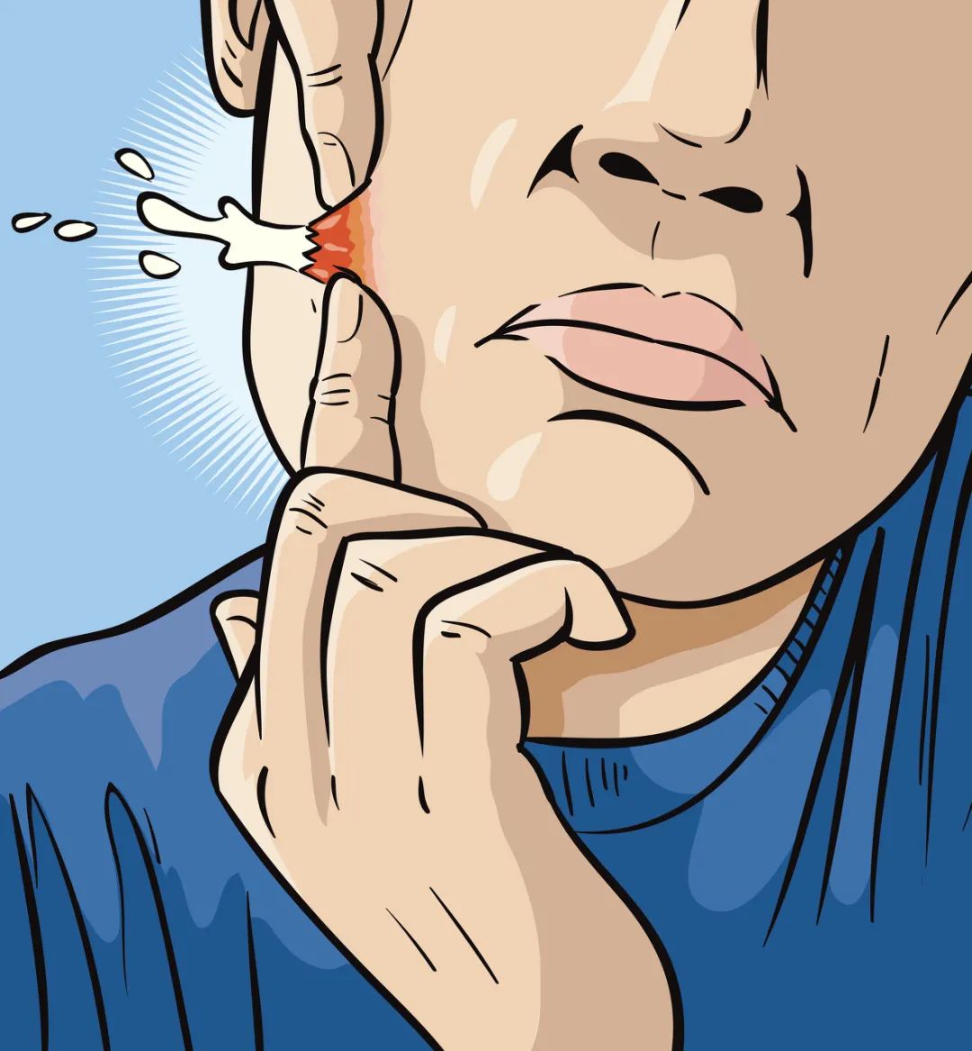 绝对不能挤的痘痘一般长什么样,哪里的痘痘不能挤