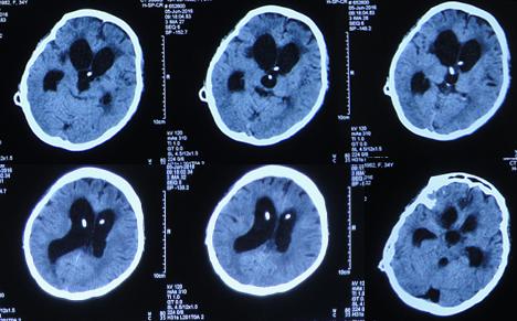 结核性脑积水,脑膜炎脑积水要治疗多久