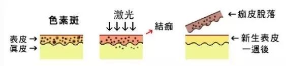 祛斑的误区，你遇到过几个？
