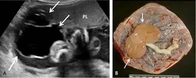 临床上最常见的异常胎盘,前置胎盘和低置胎盘超声