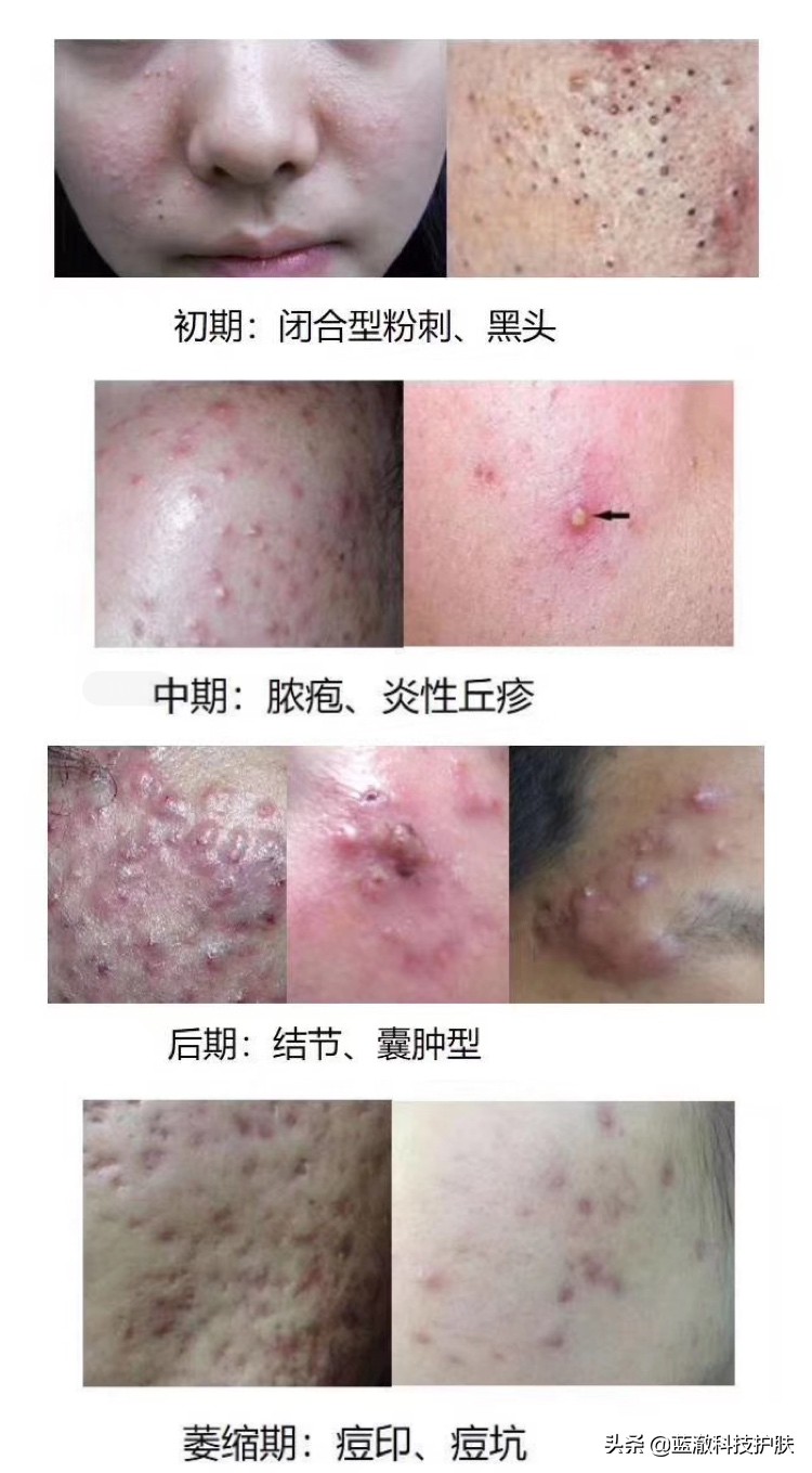 被痘痘践踏的自尊心有救了,坚持做好这五点,让你找回自信!