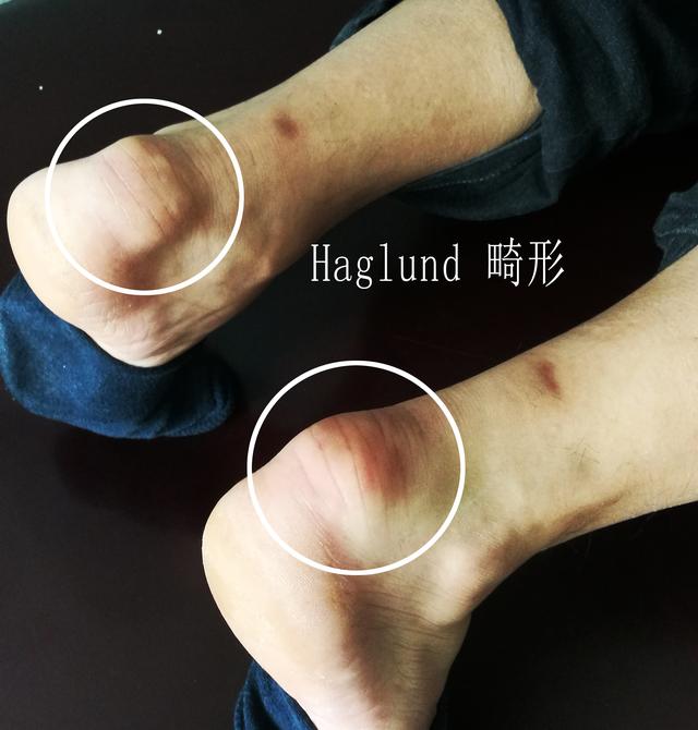 足跟疼痛教你一招百试百灵,早起落地脚疼