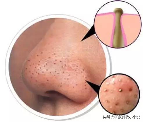 脸蛋油腻、毛孔粗大、鼻子起皮是怎么引起的呢？日常护肤小常识