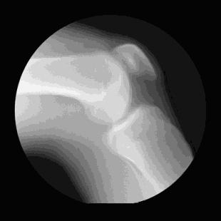 氨糖并非骨科神药,氨糖不是神药看专家怎么说