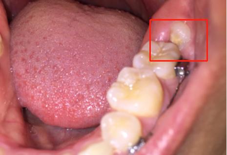智齿冠周炎疼痛最快缓解办法,智齿冠周炎疼痛难忍怎么办