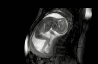 准妈妈孕晚期胎动剧烈,准妈妈胎动动作代表什么