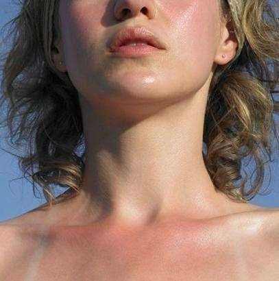 阳光浴严重晒伤怎么办,晒伤怎么预防