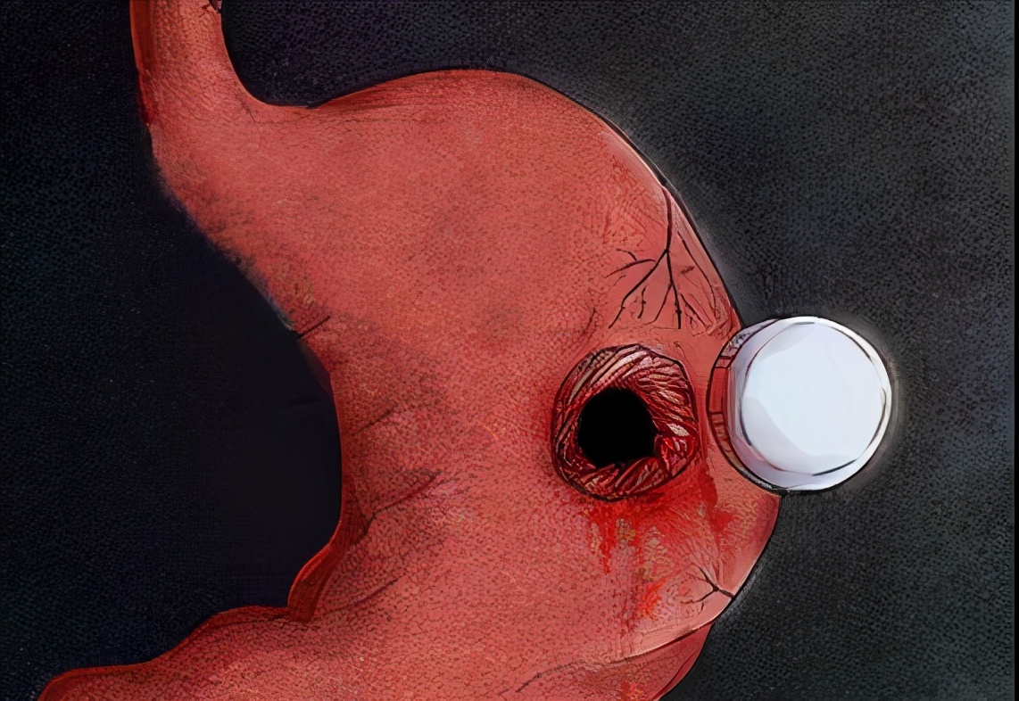 胃溃疡严重后果是什么,胃溃疡导致的后果