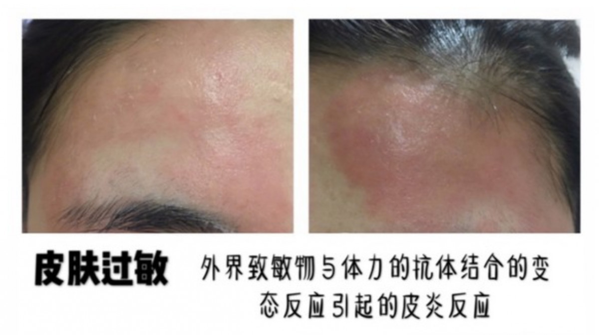 敏感肌肤护肤禁忌,敏感肌肤护肤正确方法