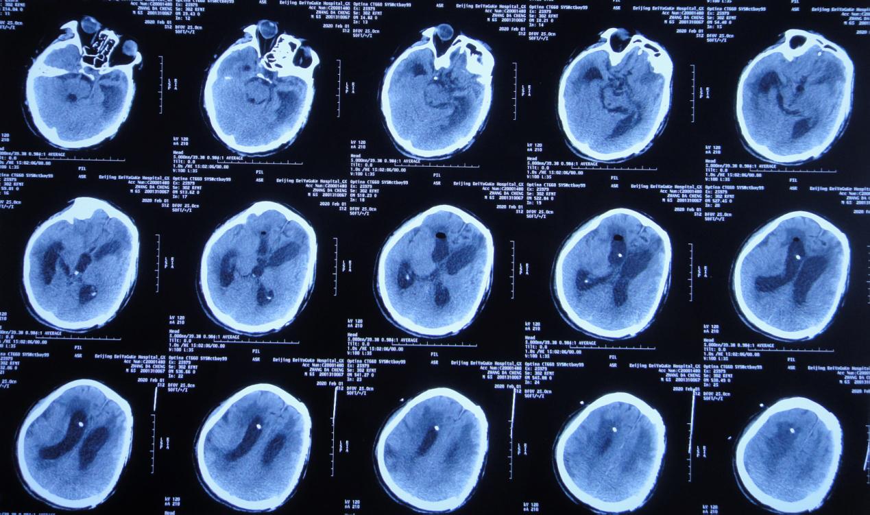 颅脑外伤术后脑积水,脑外伤脑积水颅骨缺失