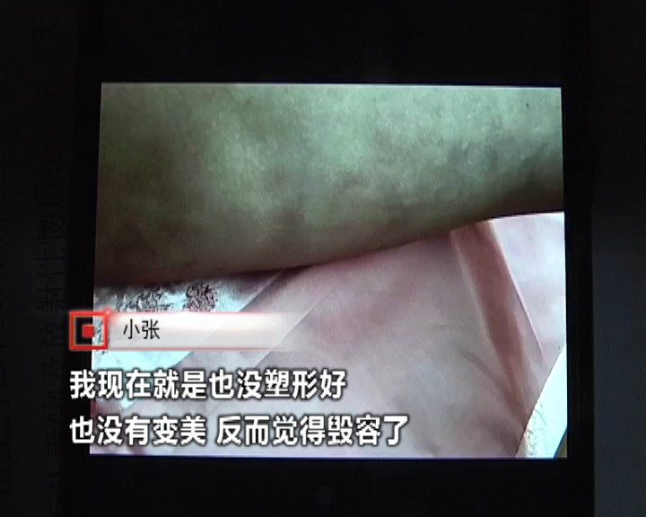 女子抽脂术后皮肤坏死,抽脂后身上掉皮