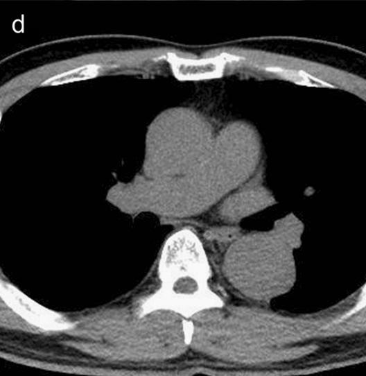 胸部Ct平扫能查出主动脉夹层吗,主动脉夹层cta影像图片解读