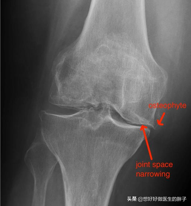 辟谣膝关节,年轻人膝盖有骨刺能根治吗