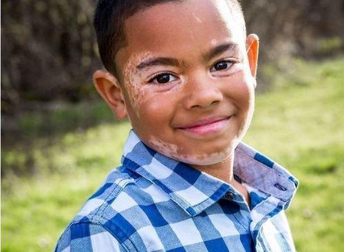 白癜风好转的迹象白斑的颜色,白癜风白斑变明显了