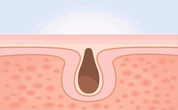 脸上毛孔粗大怎么办要如何改善,脸上毛孔粗大用什么办法解决最好