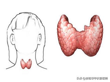 一般有甲状腺结节多大需要手术,得了甲状腺结节要不要紧如何治疗