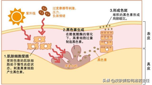 脸上有黑色素沉着斑怎能治好,脸上有色斑的护肤教程