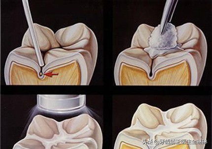 儿童蛀牙了能做窝沟封闭么,儿童蛀牙还能做牙窝封闭吗