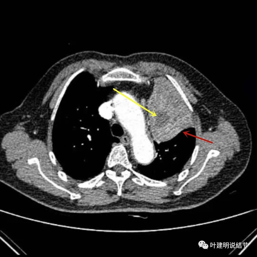 高龄肺癌靶向治疗效果,高龄老人肺癌早期适合放疗吗