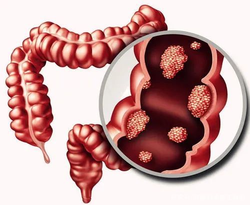 “菊花”不适，不一定都是“痔疮”的锅